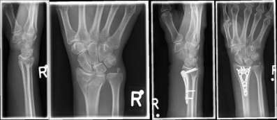 Handgelenk 3 Handgelenk 3